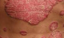 Is It Normal to Develop Adult Acne After Moving to Dubai