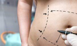 Is It Safe to Get a Tummy Tuck in Dubai If I Have Diabetes or Other Conditions