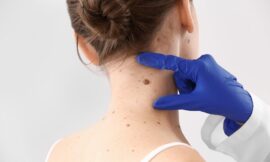 Is Skin Tag Removal in Dubai Covered by Health Insurance