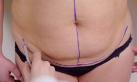 Liposuction for Men: Sculpted Chest & Abs