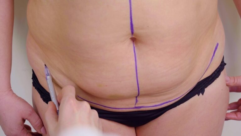 Read more about the article Liposuction for Men: Sculpted Chest & Abs