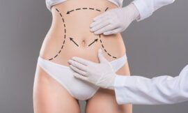 Achieve Your Dream Body with Liposuction