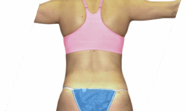 Can Liposuction Treatment Help You Achieve Your Body Goals?