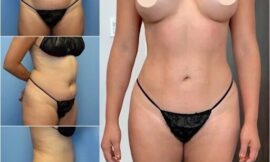 What is Body Contouring in Dubai and How Can It Help You?