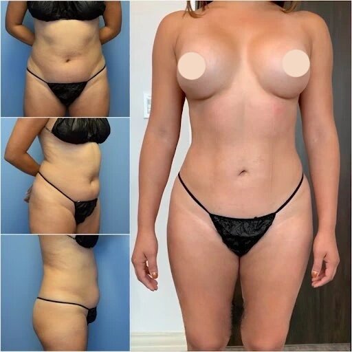 Read more about the article Body Contouring in Dubai: A Complete Overview of the Procedure