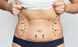 Liposuction Mastery What Best Liposuction Doctors in Dubai Says