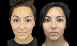 Celebrity Botox Trends That the Best Doctors in dubai Are Embracing