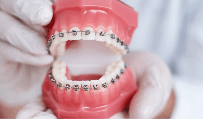 Read more about the article Say Goodbye to Dental Insecurities with Timely Braces
