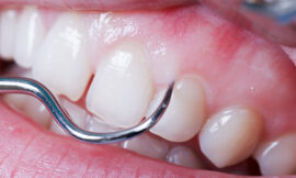 How Can Periodontics Services in Mississauga Help Treat Gum Disease?