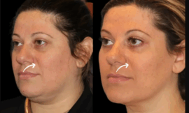 What to Expect During Sculptra Fillers Treatment in Dubai