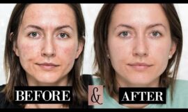 How to Care for Skin After Microneedling for Melasma