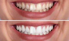 Whiter Smiles Await: Transform Your Teeth with Expert Care