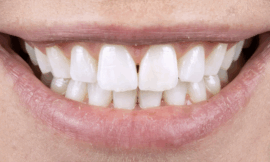 Smile Transformation: Teeth Whitening Tips That Deliver