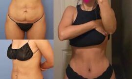 How Tummy Tuck in Dubai Can Improve Your Quality of Life
