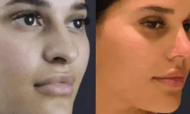 Affordable and Best Rhinoplasty Surgeon in Dubai
