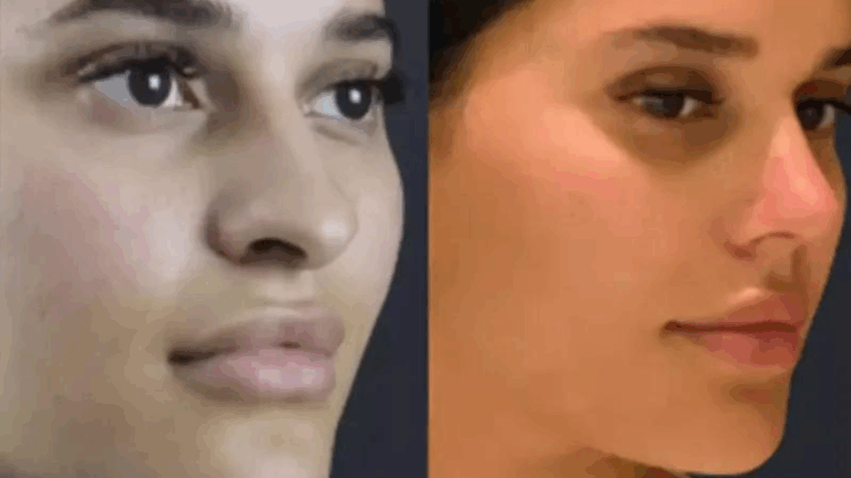 Read more about the article Affordable and Best Rhinoplasty Surgeon in Dubai