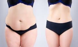 What Are the Hidden Costs of Getting a Tummy Tuck in Dubai