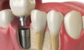 What Are the Most Common Risks of Dental Implants in Dubai