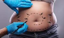 What Kind of Diet Will I Need After Bariatric Surgery in Dubai