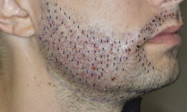 What’s the Difference Between FUE and FUT for Beard Hair Transplants in Dubai