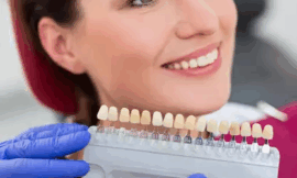 Will Dental Veneers Stain or Discolor Over Time in Dubai