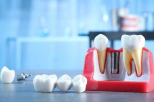 Smilo Dental Implants