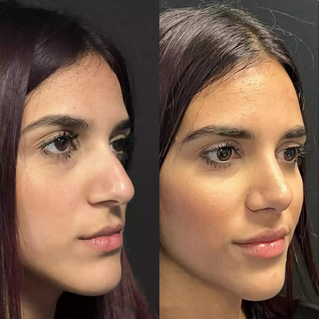 H-Rhinoplasty-11