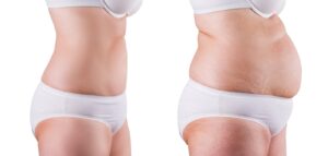 How a Tummy Tuck Complements Fitness Goals