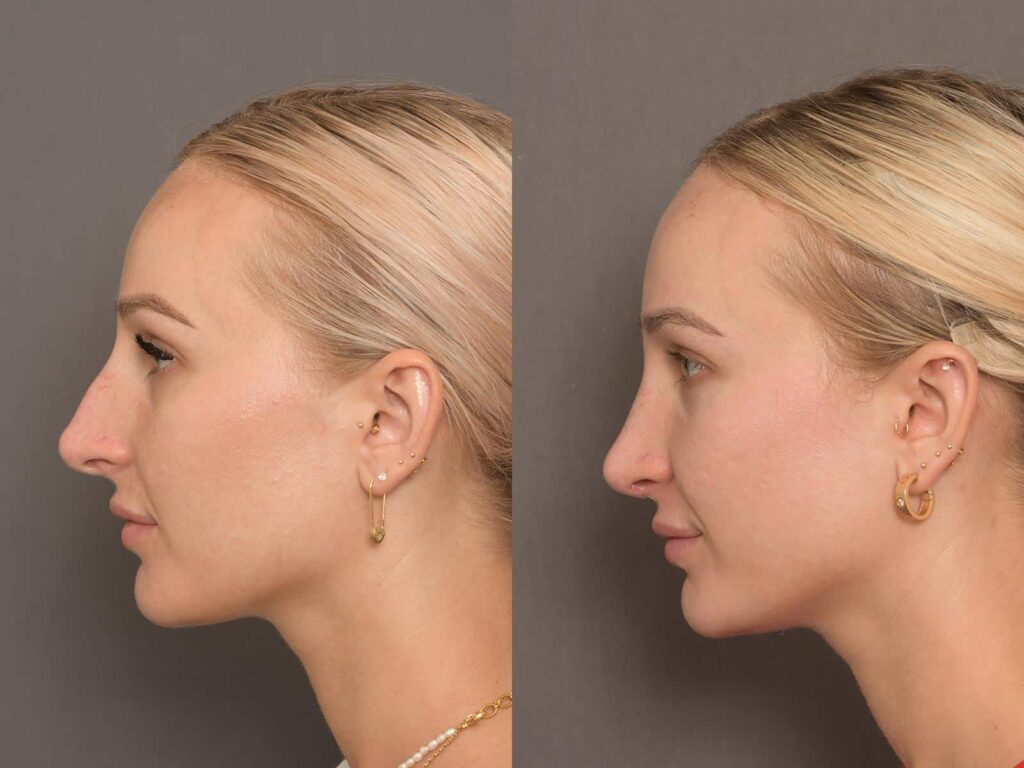 Understanding Facial Angles in Rhinoplasty Desi