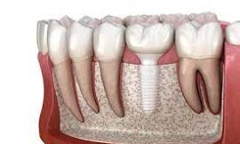 Can I Trust Dental Implant Clinics in Dubai with My Medical History?