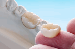 dental crown baltimore maryland