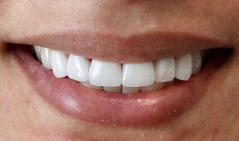 Read more about the article Dental Veneers: Fixing Imperfections with Style