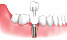 Do Dental Implants in Dubai Look and Feel Natural?
