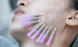 Get Glowing with Thread Lift Treatment