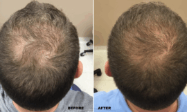 Will PRP Work If I’ve Already Tried Other Hair Loss Treatments Without Success?