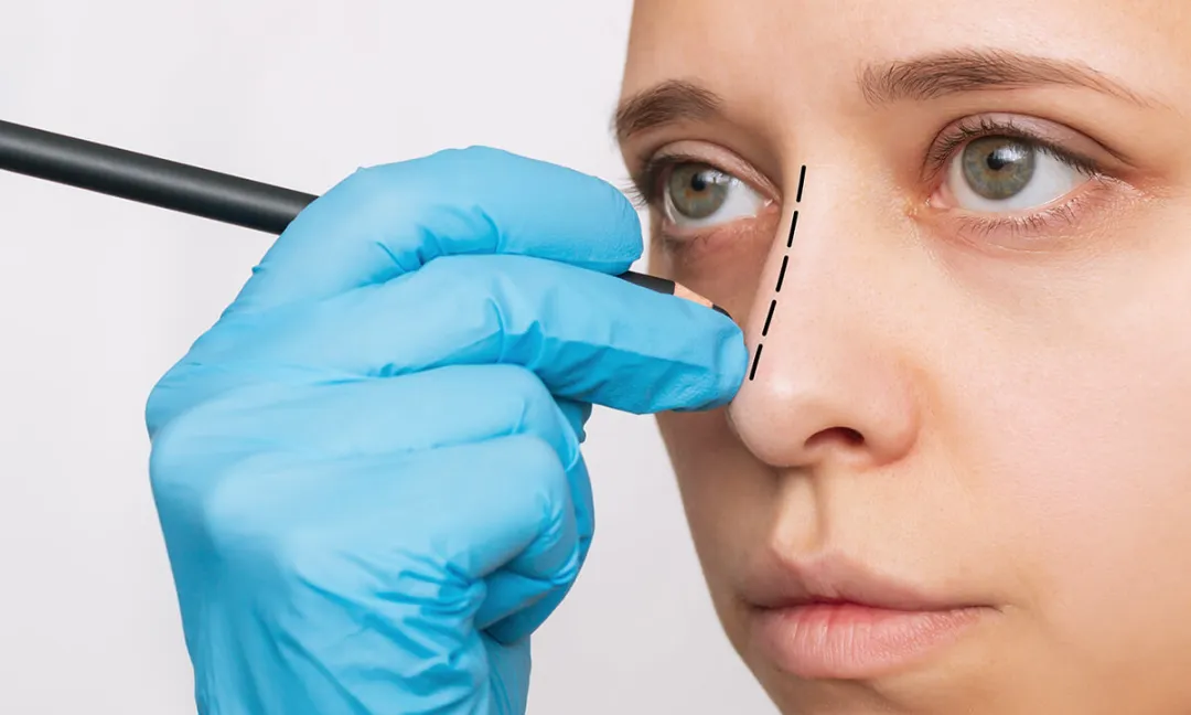 Alarplasty | Royal Clinic: Personalized Nose Refinement