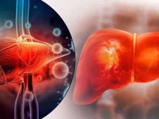 Ayurveda-Liver-Cirrhosis-Treatment