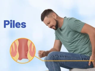 Ayurvedic-treatment-for-fissure-1