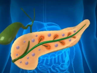 Distal-Pancreatectomy_-A-Key-Surgery-for-Pancreatic-Cancer-Treatment-in-Pune