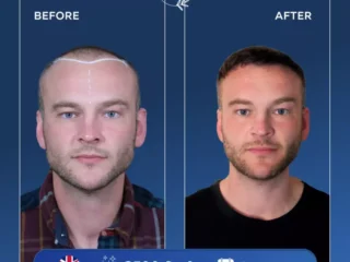 before-after-4-768×768-1