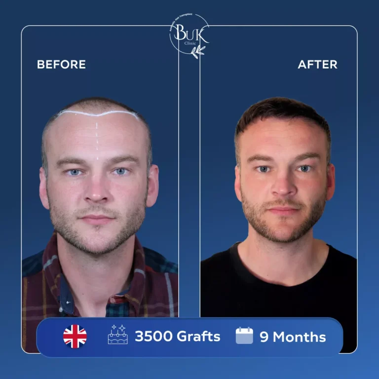 Best Hair Transplant in Turkey | Buk Clinic