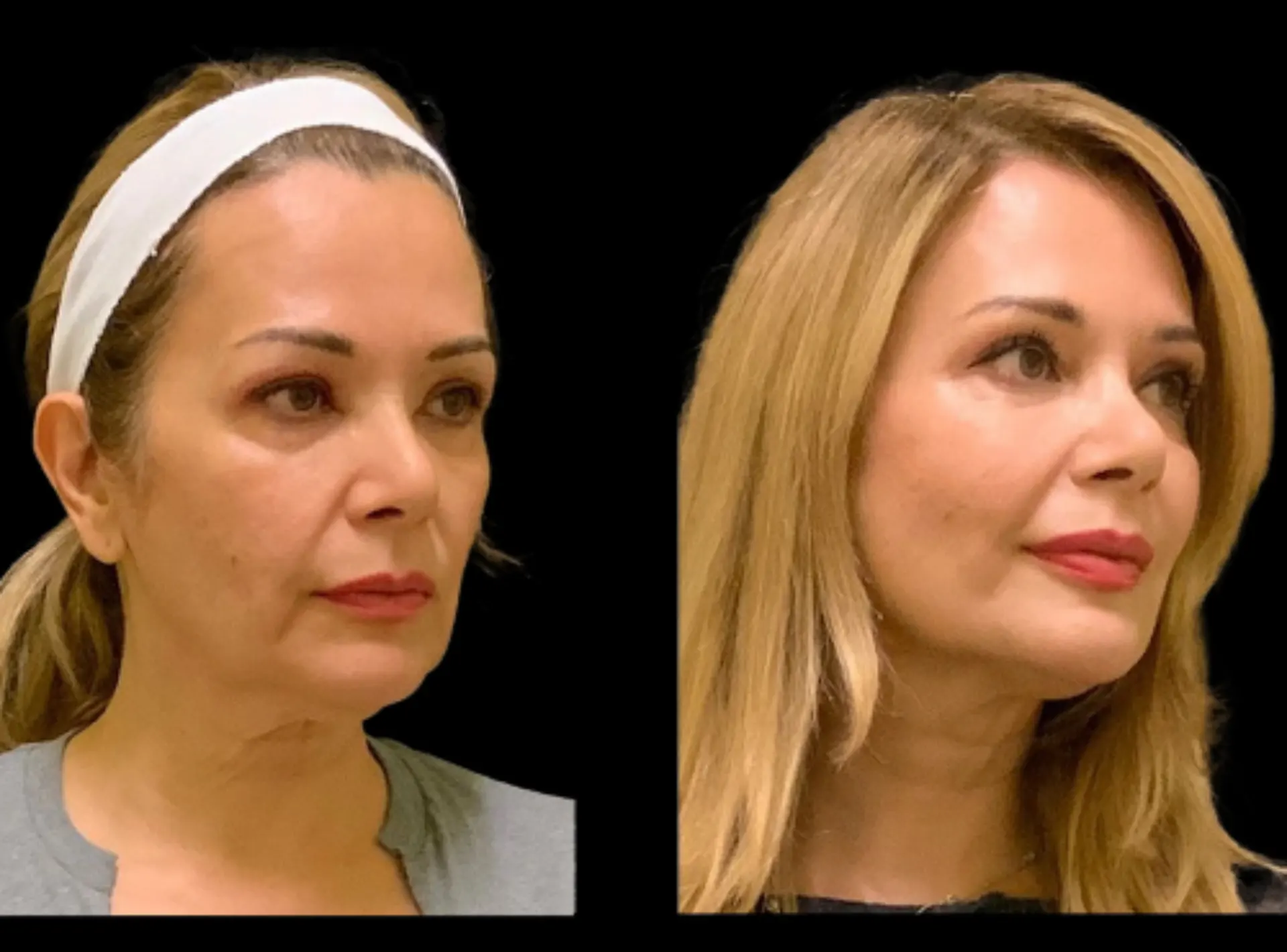 Skin Whitening in Dubai – Safe & Effective Brightening Treatments Guide