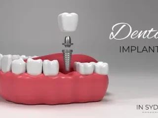 dental-implants-in-sydney