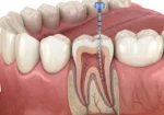 Root Canal Treatment Cost in Noida