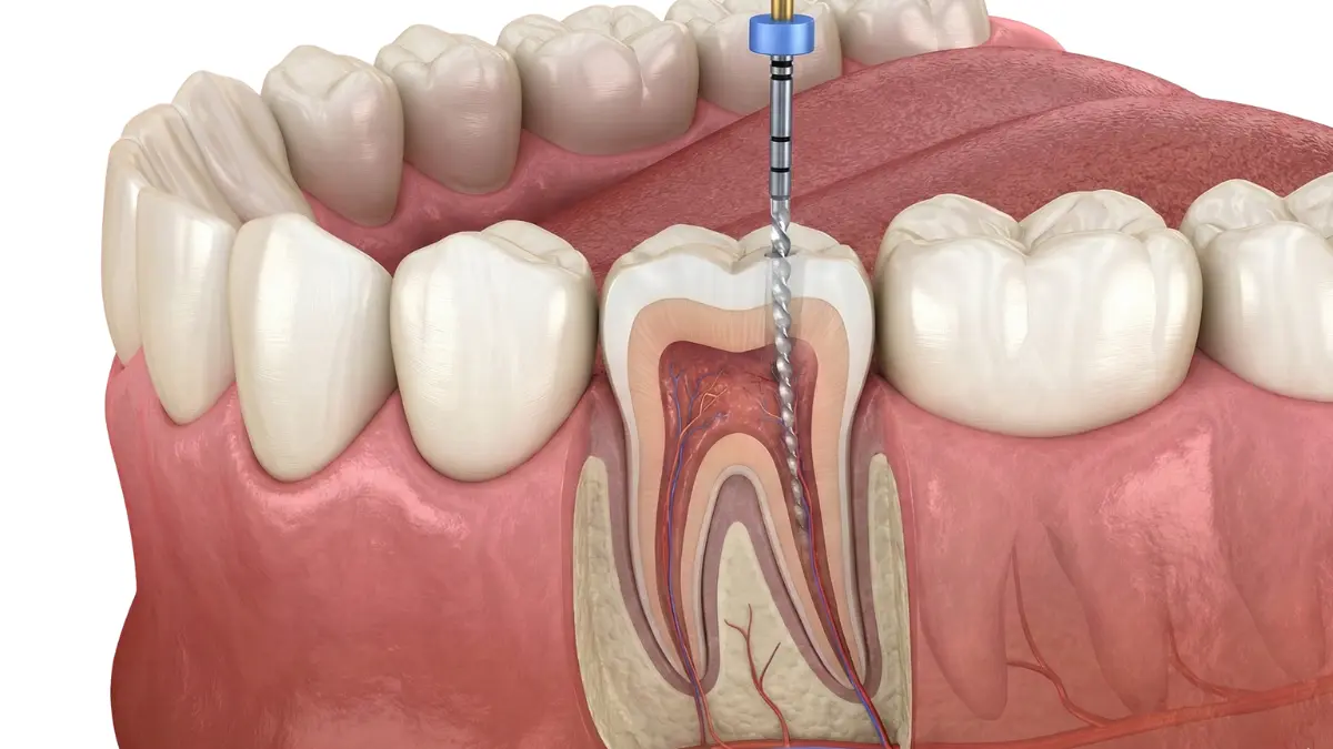 Root Canal Treatment Cost in Noida