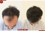 Crown – The Hair Transplant Experts