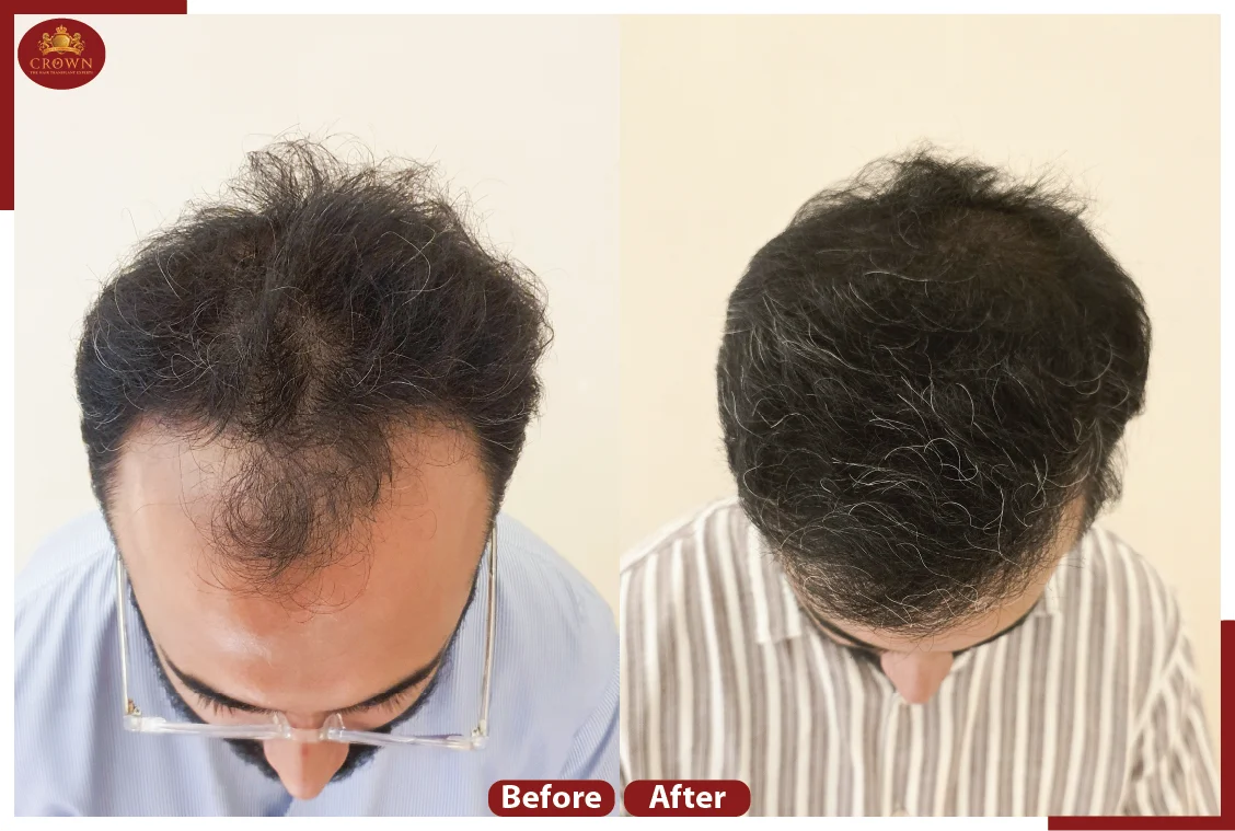 Crown – The Hair Transplant Experts