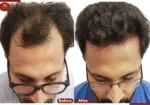 Crown – The Hair Transplant Experts