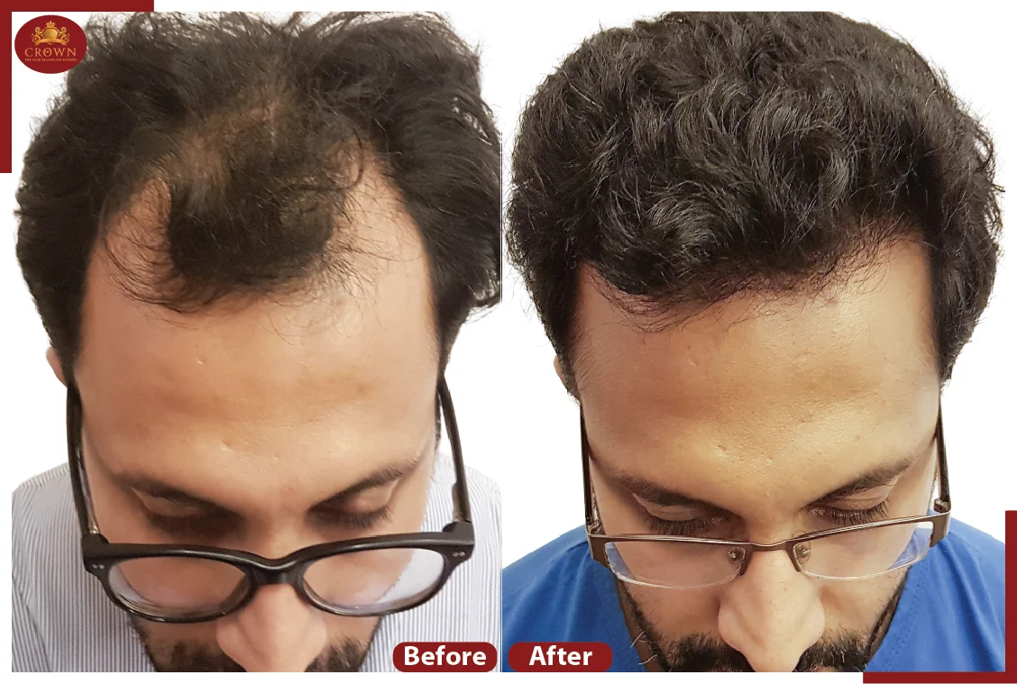 Crown – The Hair Transplant Experts