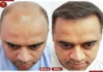 Crown – The Hair Transplant Experts